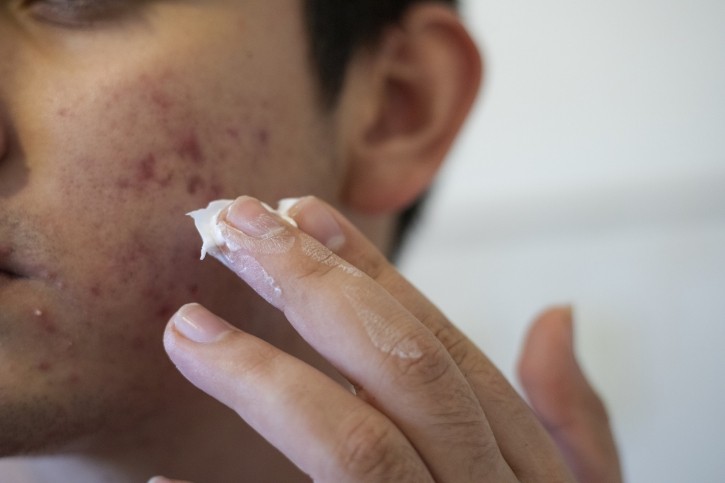 Of important note, “analysis for native benzene was performed on 99 BPO containing acne medication products and resulted in the detection of benzene in 94 products, often with values well above 2 ppm in an initial analysis,” stated Valisure’s Citizen’s Application. © DarioGaona Getty Images